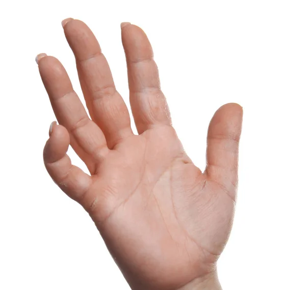 Kvinnlig hand med dermatit — Stockfoto