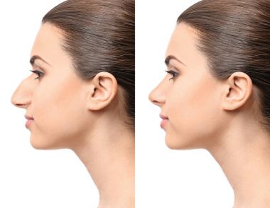 Young woman before and after rhinoplasty clipart