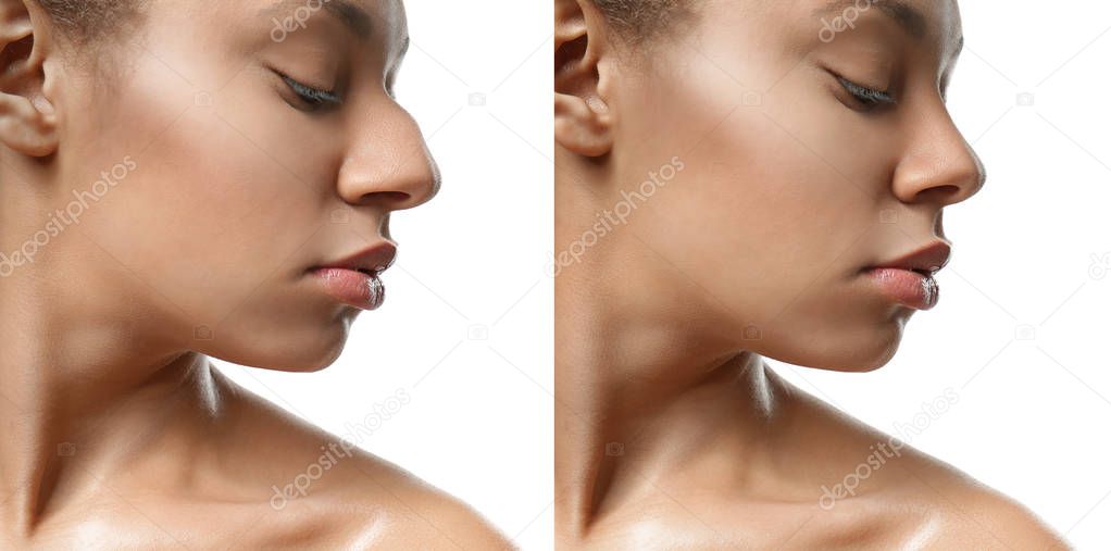 Young woman before and after rhinoplasty