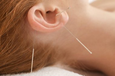 Woman getting acupuncture treatment clipart