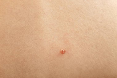 Doğum lekesi ile insan derisi