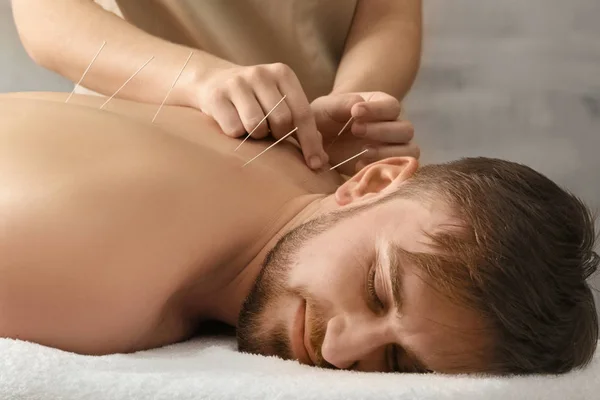 Young man getting acupuncture treatment
