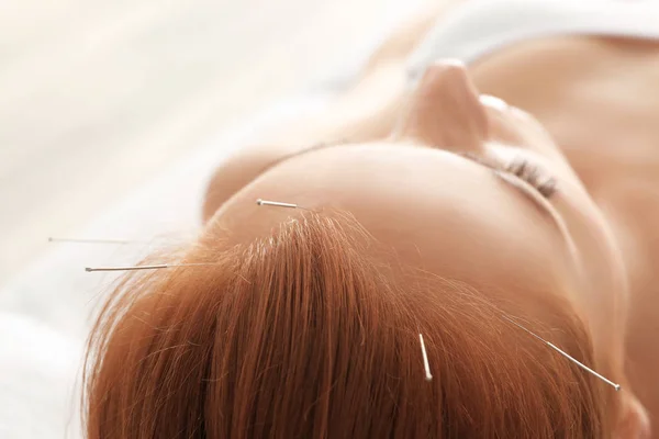 Therapie van vrouwelijke hoofd met prikken acupunctuurnaalden — Stockfoto