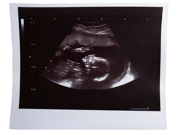 Baby ultraljudsundersökning — Stockfoto