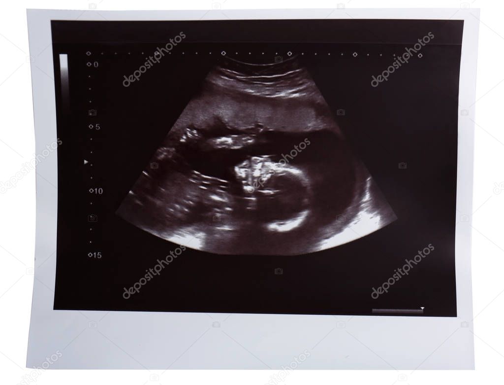 Ultrasound baby scan