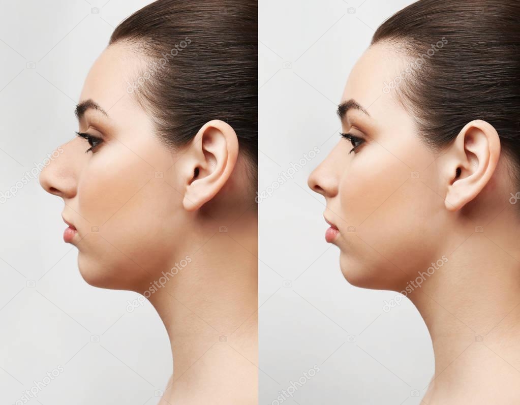Young woman before and after rhinoplasty on light background. Plastic surgery concept