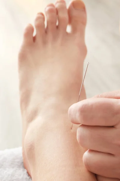 Mujer recibiendo tratamiento de acupuntura — Foto de Stock