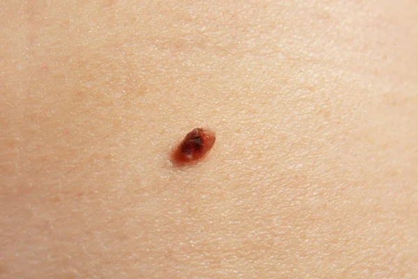 Human skin with birthmark — Stock Photo, Image