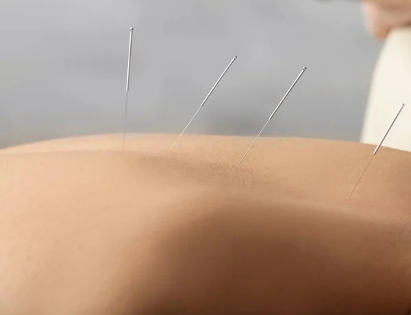 Homme recevant un traitement d'acupuncture — Photo