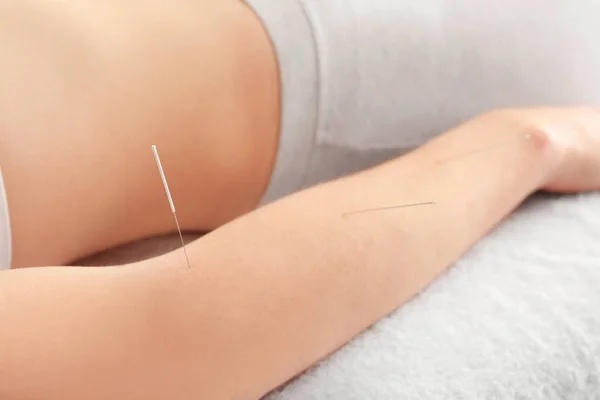 Frau lässt sich akupunktieren — Stockfoto
