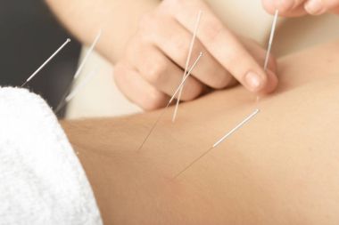 Man getting acupuncture treatment clipart