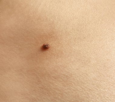 Doğum lekesi ile insan derisi