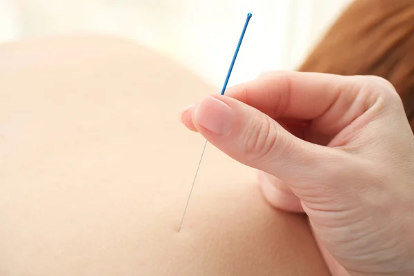 Points d'acupuncture stimulants pour la femme — Photo