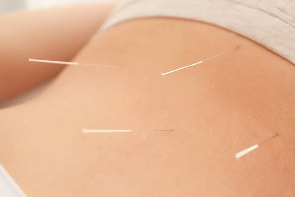 Mulher recebendo tratamento de acupuntura — Fotografia de Stock