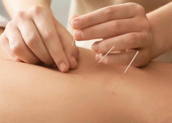 Homme recevant un traitement d'acupuncture — Photo