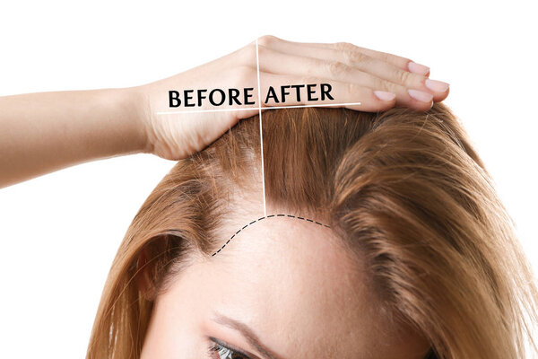 Woman before and after hair loss treatment on white background