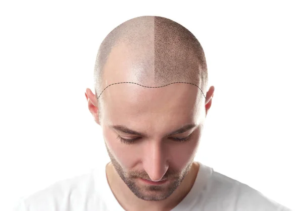 Чоловік до і після лікування втрати волосся на білому тлі — стокове фото
