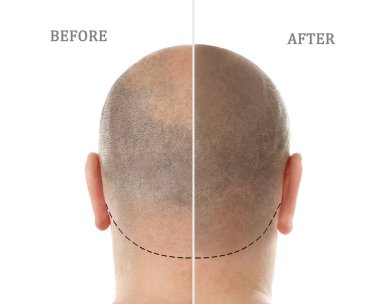 Man before and after hair loss treatment on white background clipart