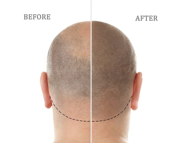 Homme avant et après traitement de perte de cheveux sur fond blanc — Photo