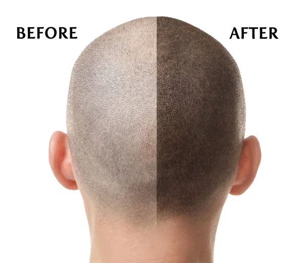 Pria sebelum dan sesudah perawatan rambut rontok dengan latar belakang putih — Stok Foto