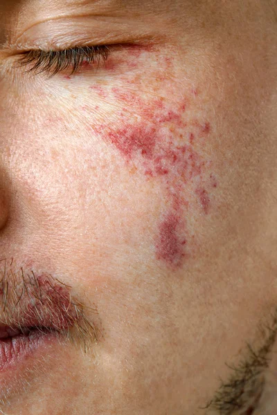 Young Man Birthmarks Closeup — Stock Photo, Image