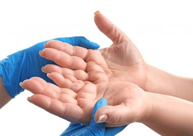 Dermatit ellerinde olan hasta