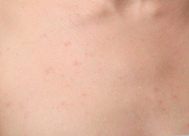 İnsan cilt sivilce ile