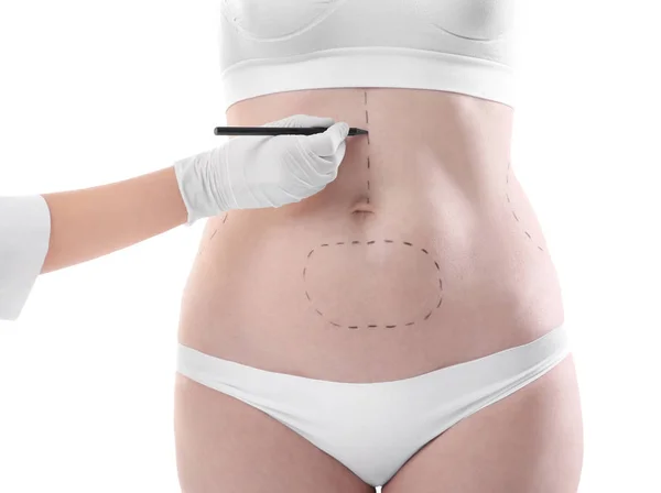 Surgeon drawing marks on female body — Stock Photo, Image