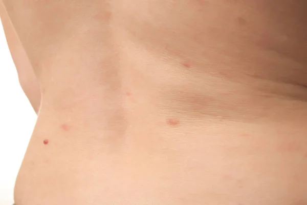 Back of woman with birthmark — Stock Photo, Image