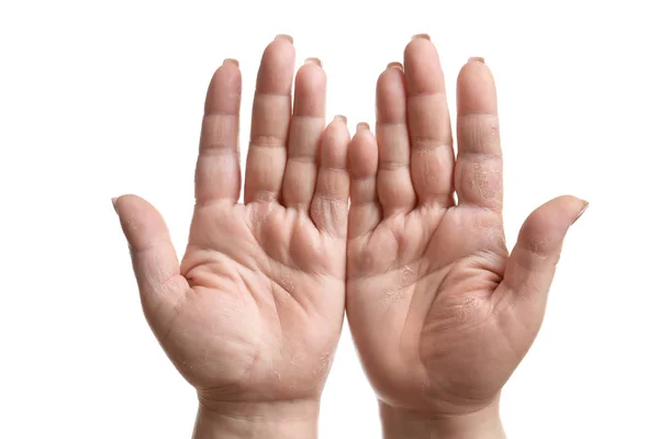 Female hands with dermatitis — Stock Photo, Image