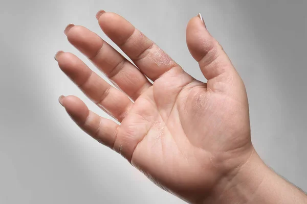 Main féminine avec dermatite — Photo
