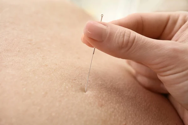 Woman stimulating acupuncture — Stock Photo, Image