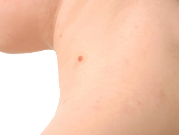Mulher com problema de pele — Fotografia de Stock