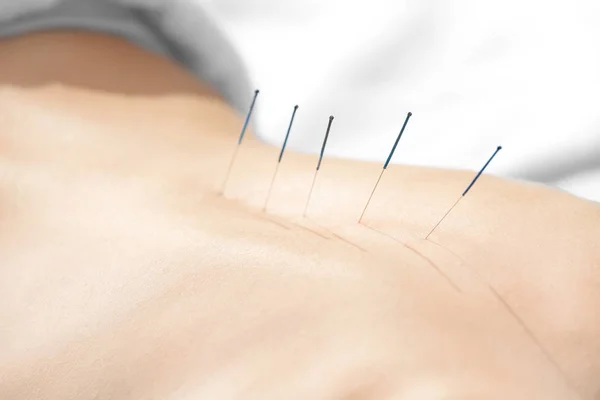 Kvinna genomgår akupunkturbehandling — Stockfoto