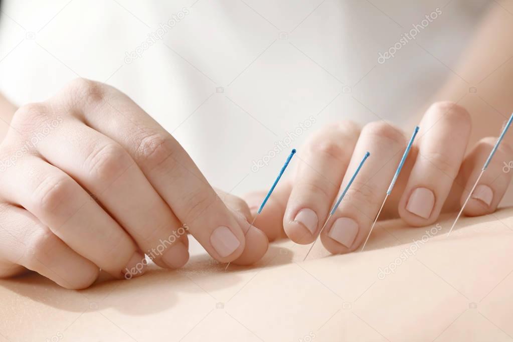 woman undergoing acupuncture treatment