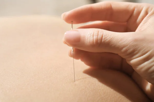 Vrouw stimulerende acupunctuurpunten — Stockfoto