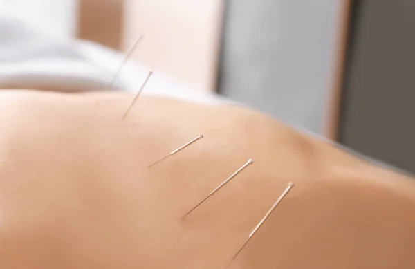 Woman undergoing acupuncture treatment — Stock Photo, Image