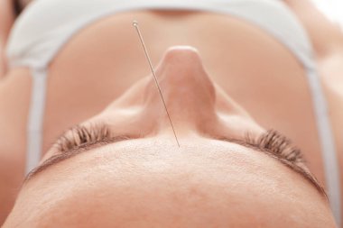 female head with acupuncture needle clipart