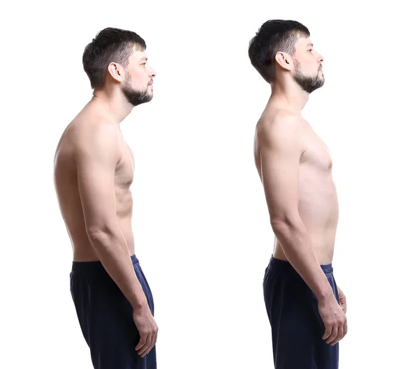 Sanierungskonzept. Collage eines Mannes mit schlechter und guter Haltung auf weißem Hintergrund — Stockfoto