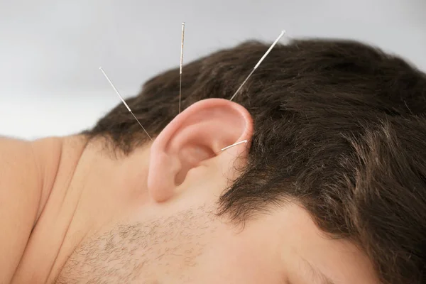 Hombre sometido a tratamiento de acupuntura — Foto de Stock