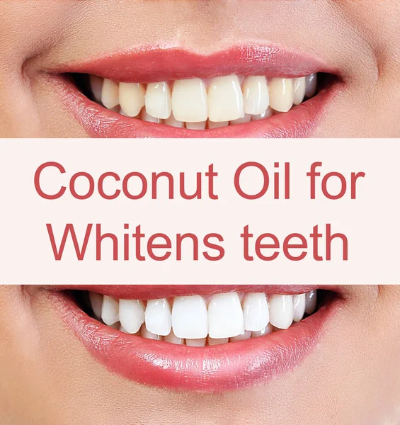 Coconut oil pulling for teeth whitening
