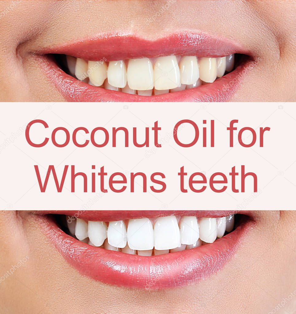 Coconut oil pulling for teeth whitening