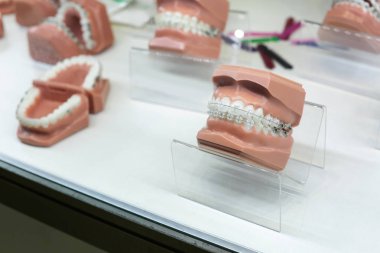 Set of jaw models with dental bracket on white shelf clipart