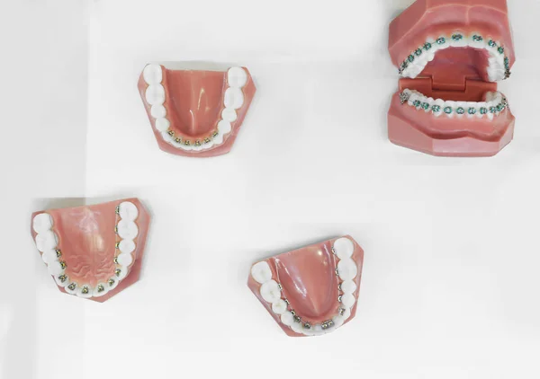 Set med käken modeller med dental fäste på vit bakgrund — Stockfoto