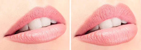 Kvinnliga läppar före och efter bröstförstoring förfarande. — Stockfoto