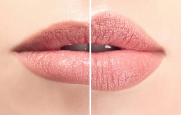 Female lips before and after augmentation procedure. — Stock Photo, Image