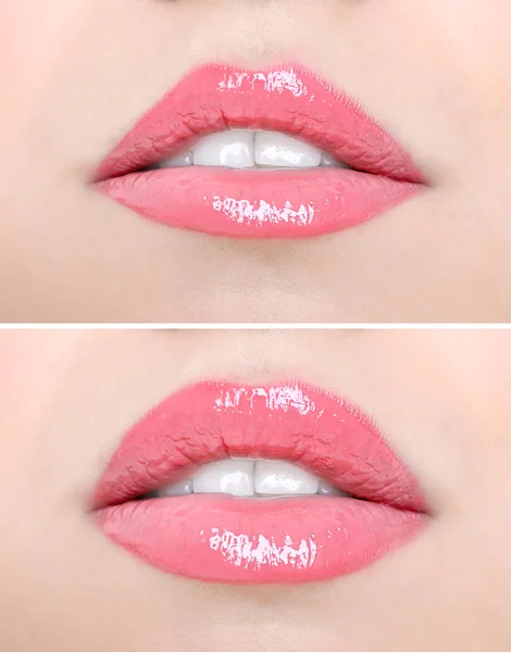 Lábios femininos antes e depois do procedimento de aumento . — Fotografia de Stock
