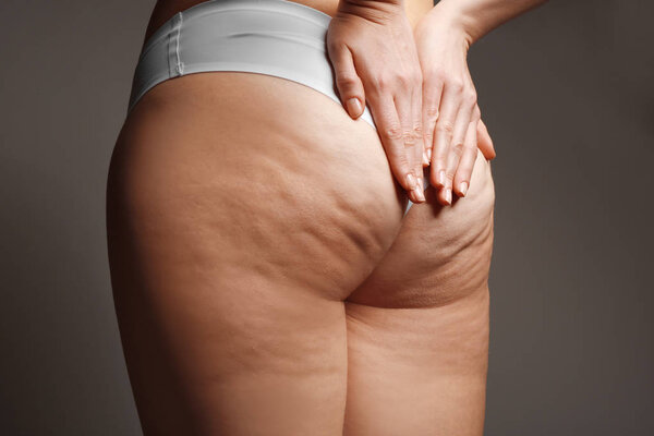 Woman with cellulite problem