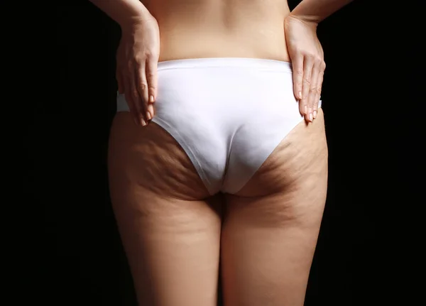 Donna con problemi di cellulite — Foto Stock
