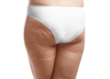 Selülit sorunu olan kadın 